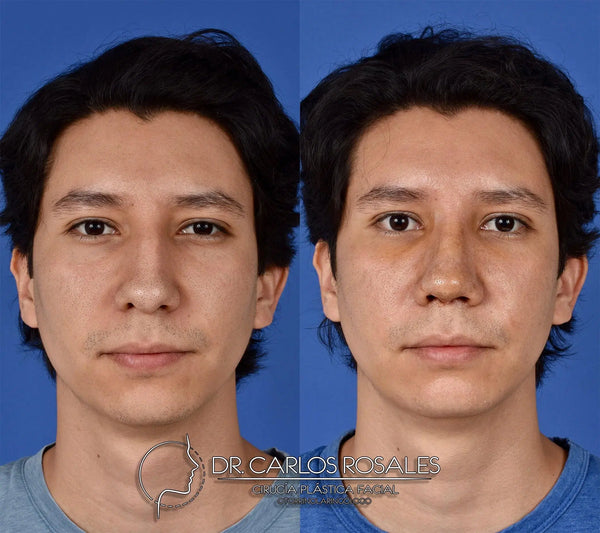 Rhinoplasty