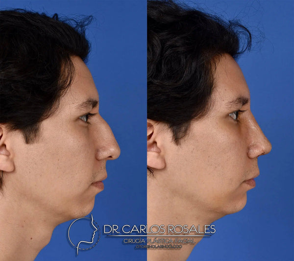 Rhinoplasty