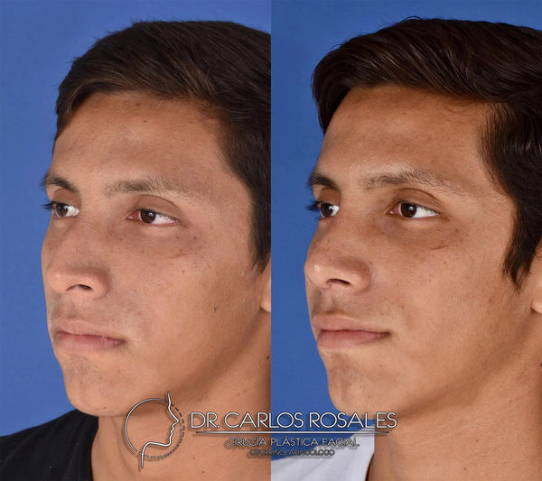 Rhinoplasty