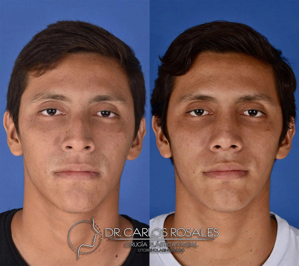 Rhinoplasty