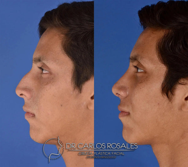 Rhinoplasty