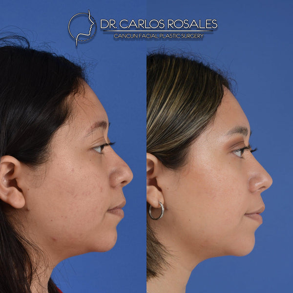 Secondary rhinoplasty