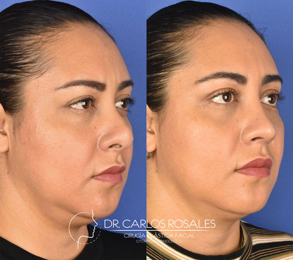 Secondary rhinoplasty