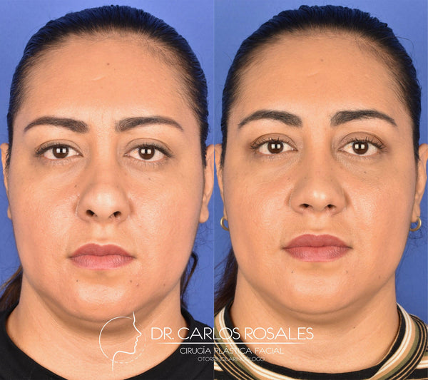 Secondary rhinoplasty