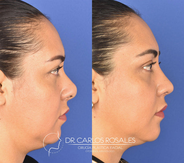 Secondary rhinoplasty