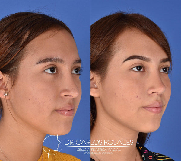 Secondary rhinoplasty