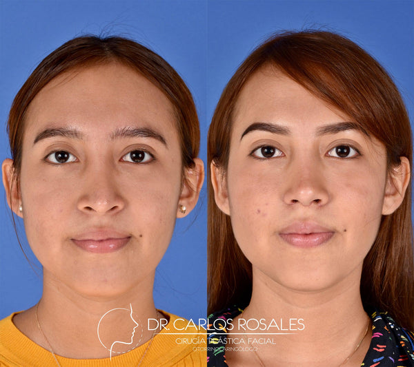 Secondary rhinoplasty