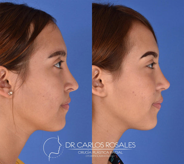 Secondary rhinoplasty