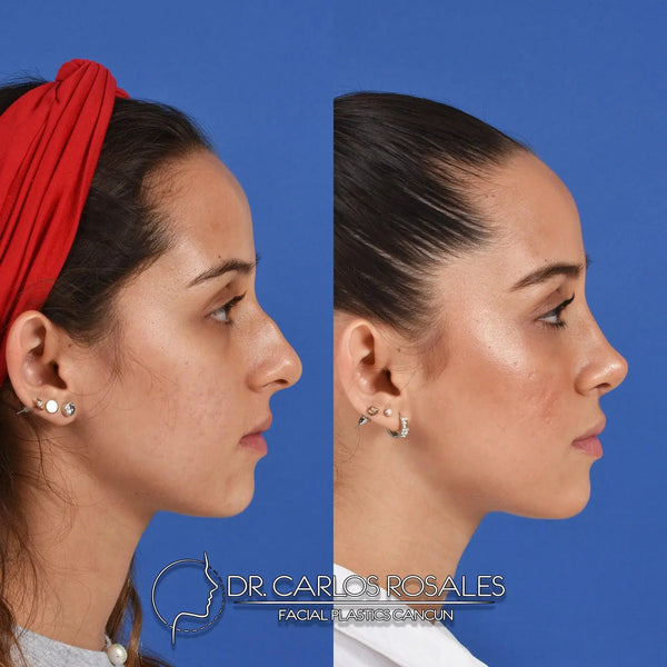 Rhinoplasty