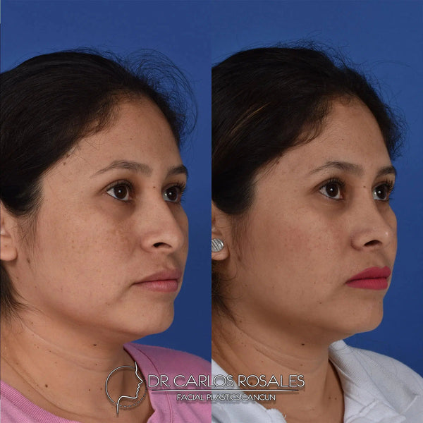 Rhinoplasty