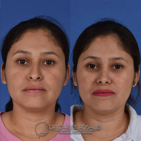 Rhinoplasty