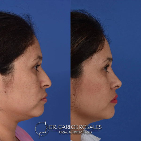 Rhinoplasty