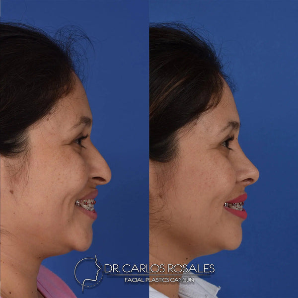 Rhinoplasty