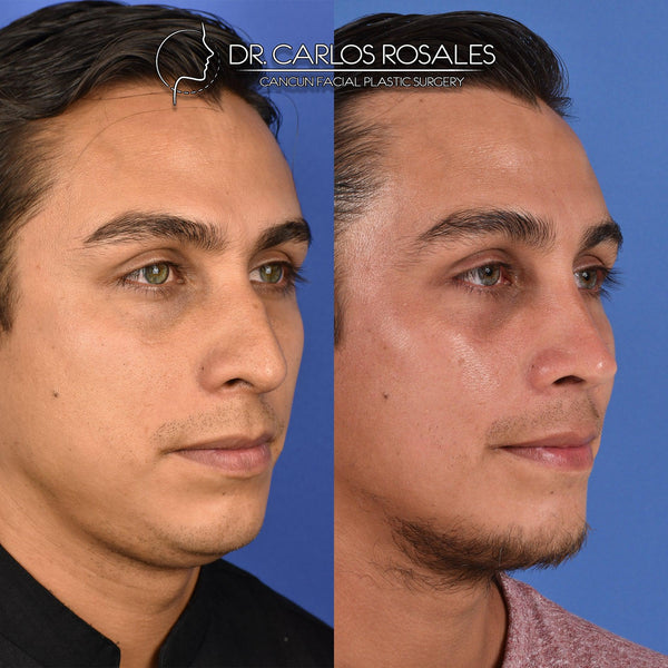 Rhinoplasty