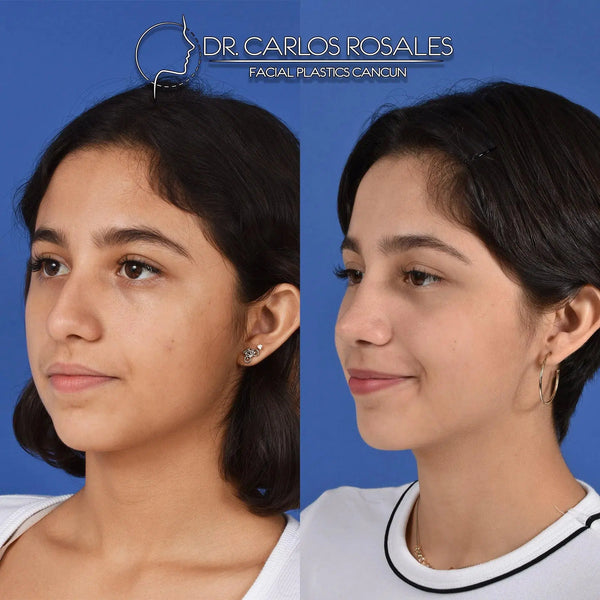 Rhinoplasty