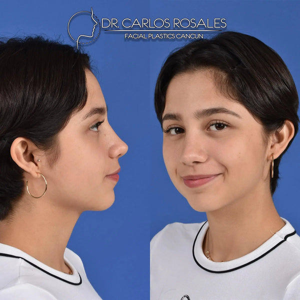 Rhinoplasty