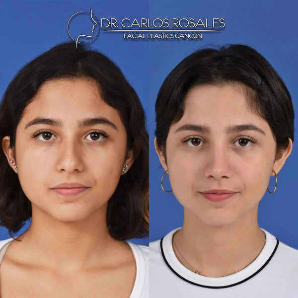 Rhinoplasty