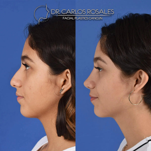 Rhinoplasty