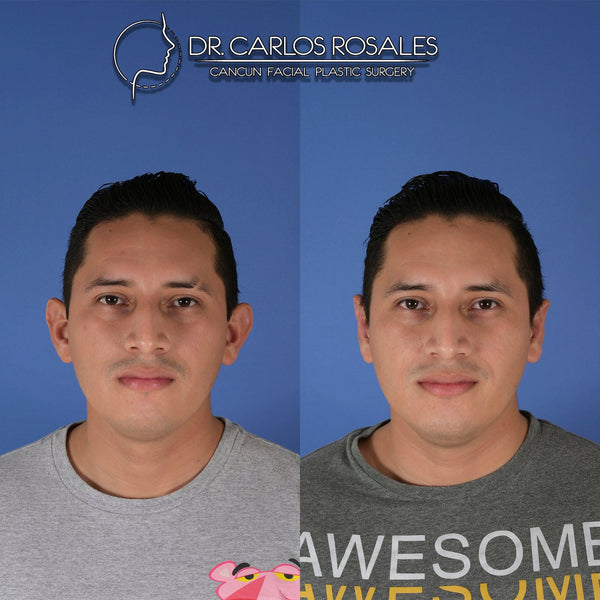 otoplasty