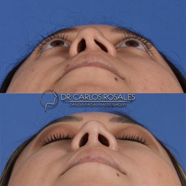 Secondary rhinoplasty