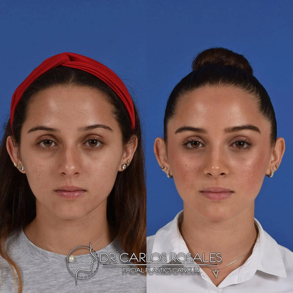 Rhinoplasty