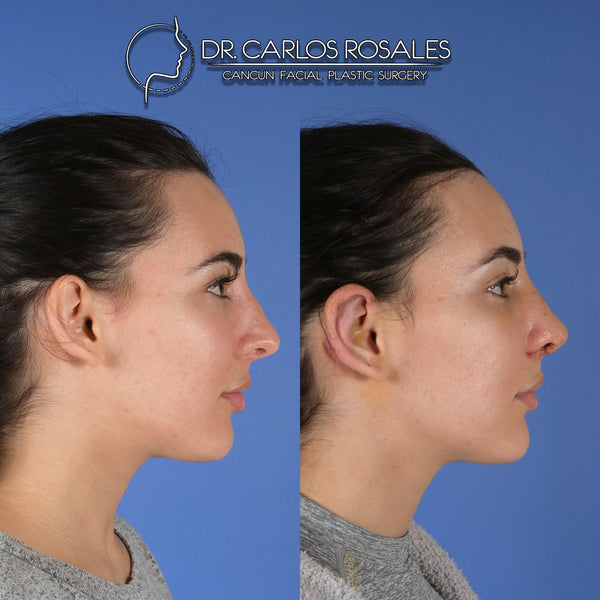 otoplasty