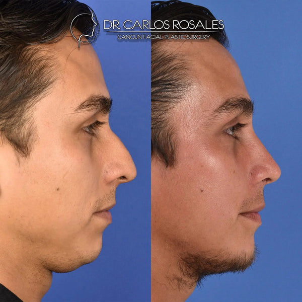 Rhinoplasty